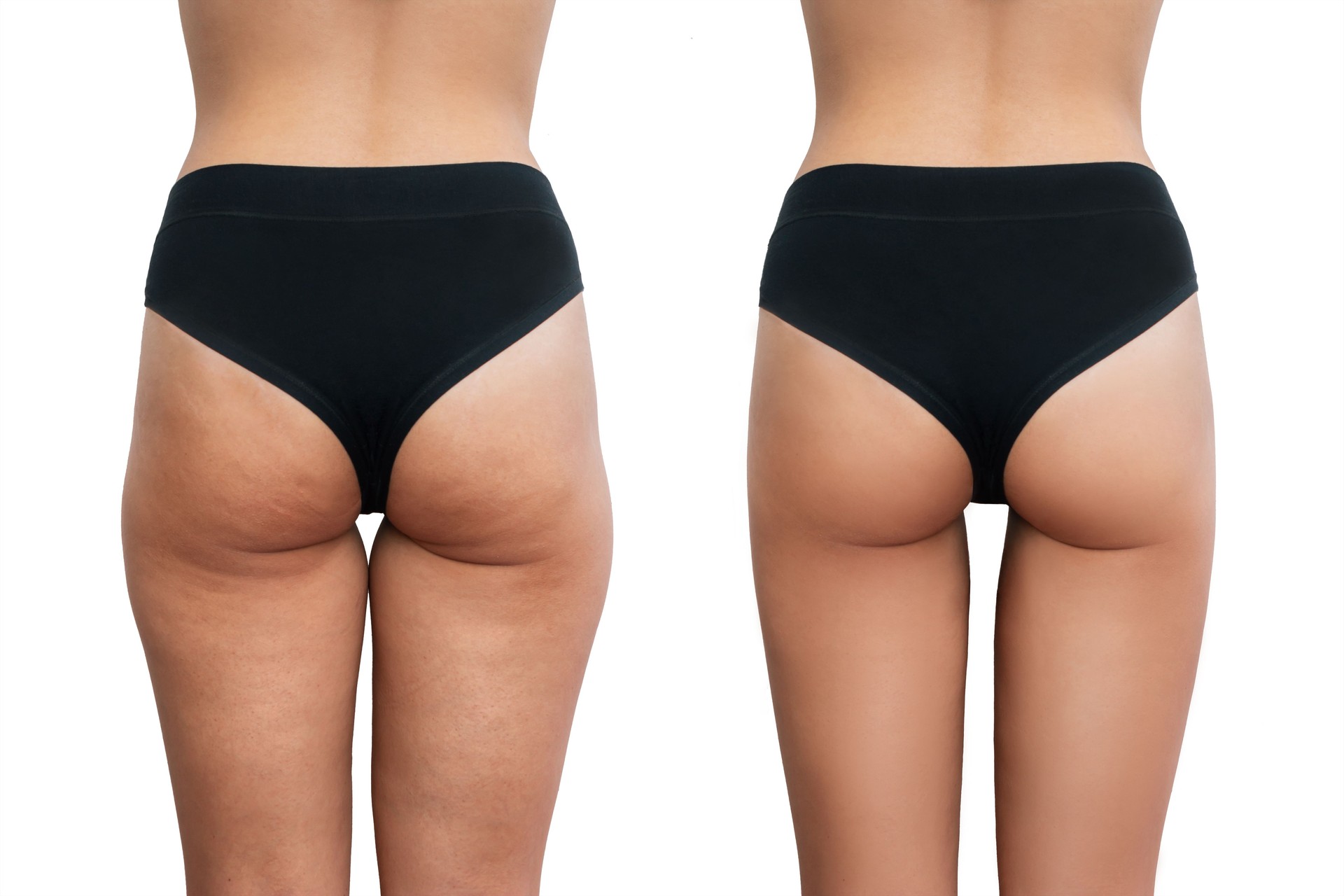 Young woman's thighs with cellulite before and after treatment isolated on white background
